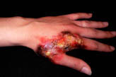 fake burn